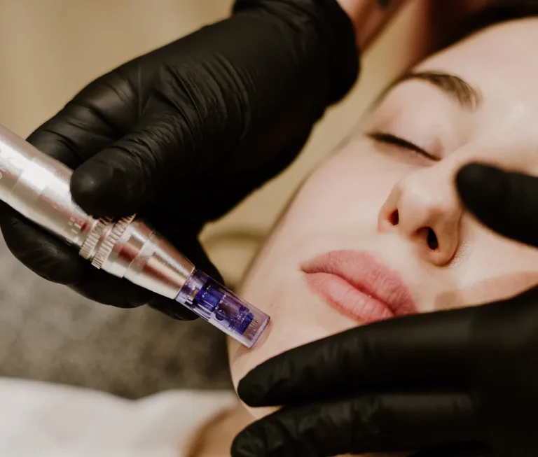 Dermapen Microneedling
