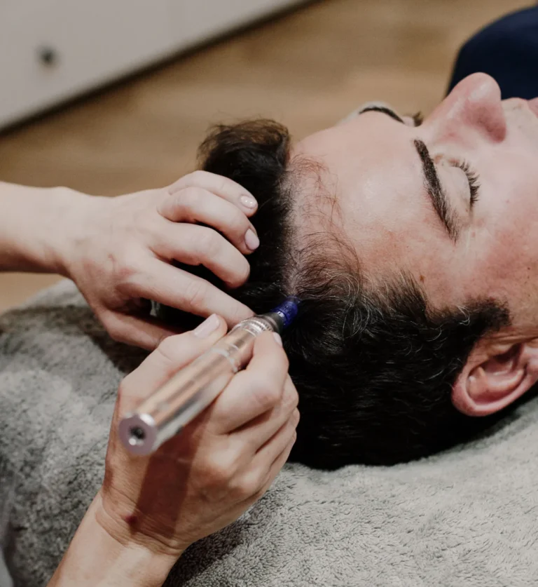 Dermapen Capilar (Microneedling)
